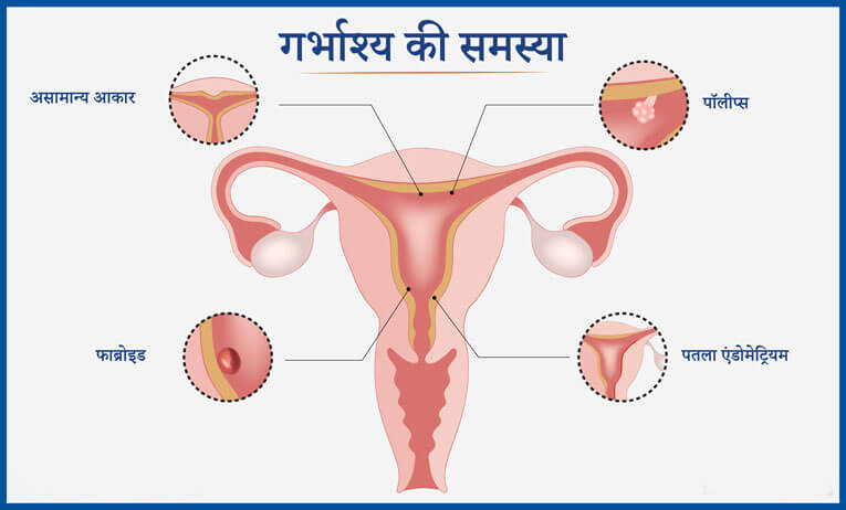 uterus-problem-in-hindi-सेक्स-के-दौरान-कंडोम-मेरे-गर्भाशय-में-रह-गया-अब-मुझ-कुंवारी-लड़की-को-क्या-करना-चाहिए